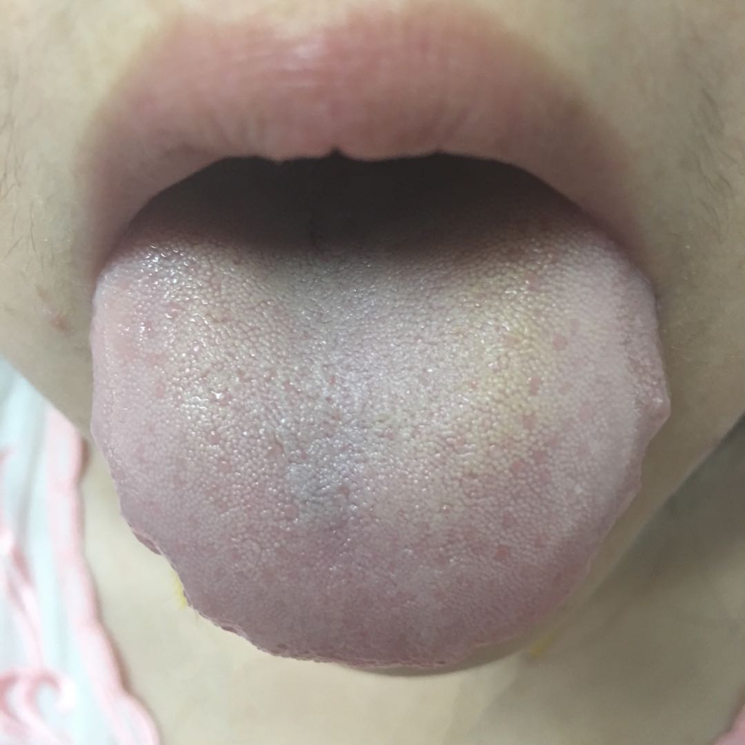 面部皮炎湿疹反反复复,反反复复起湿疹