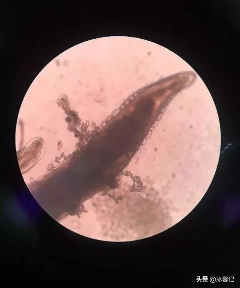 6岁女童蛲虫最简单有效的治法,孩子蛲虫痒怎么快速止痒