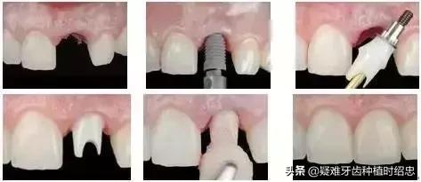 牙周炎牙齿全部掉了好装假牙吗,牙齿掉了安一颗假牙要多少钱