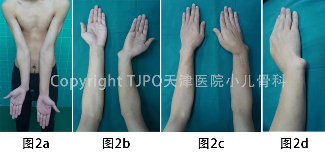 桡骨小头畸形截骨矫形,小儿尺桡骨远端发育迟缓畸形