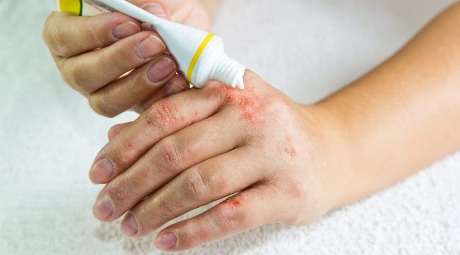 湿疹在中医里面是什么原因引起的,手掌湿疹反复开裂脱皮中医治疗