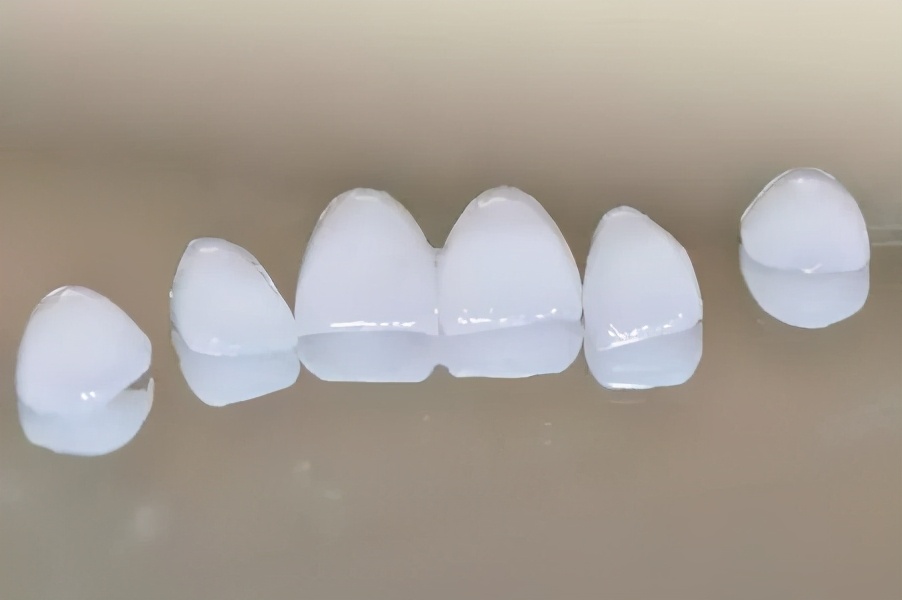 牙齿贴面能修复牙缝大的问题吗,齿科全瓷贴面美白