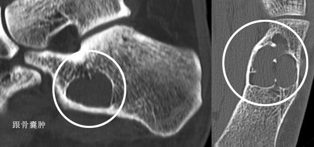 产后足跟痛是什么原因引起的,足跟痛是什么原因用什么贴