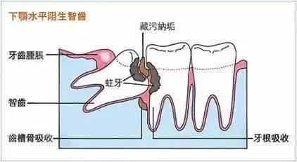 智齿冠周炎张口受限伴吞咽疼痛,智齿冠周炎一般疼痛多久