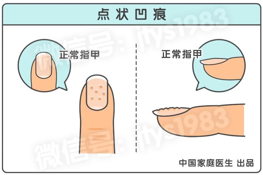 指甲全是竖条纹和白点是怎么回事,指甲竖条纹没有月牙怎么回事