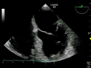 冠心病危险指数低了好还是高了好,冠心病患者防止猝死记住这五点