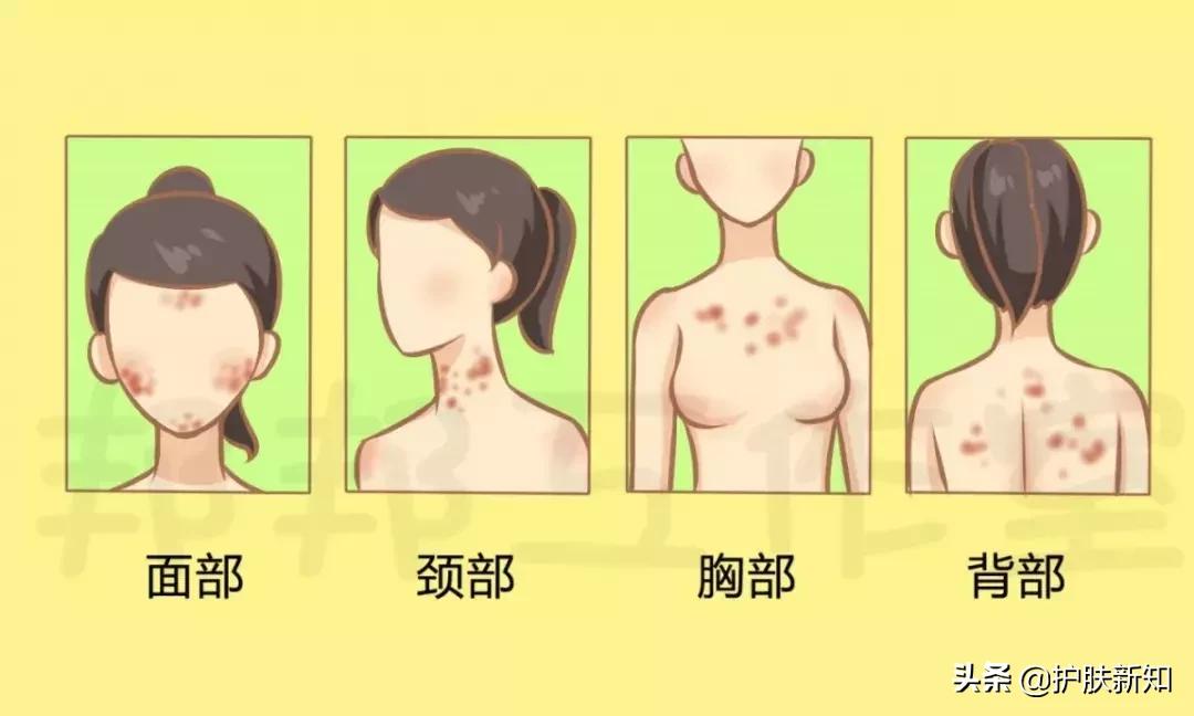 怎样彻底告别痘痘,怎样让痘痘快速消失皮肤变好