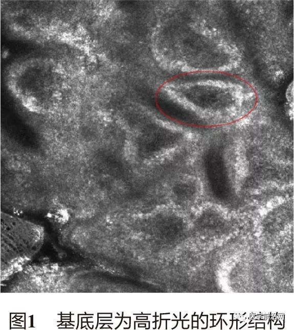 皮肤共聚焦显微镜能查什么,皮肤镜和共聚焦显微镜