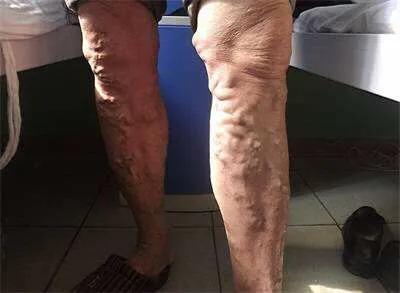 下肢静脉曲张等血管疾病是脉管炎吗？