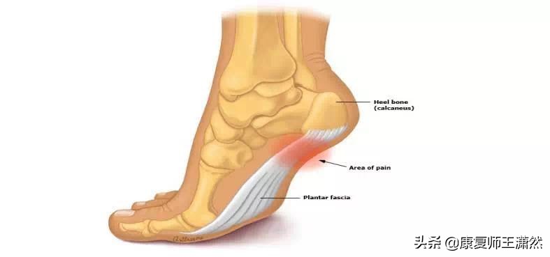 运动后脚底板持续疼痛?可能筋膜受伤!不打针不吃药4招就能恢复