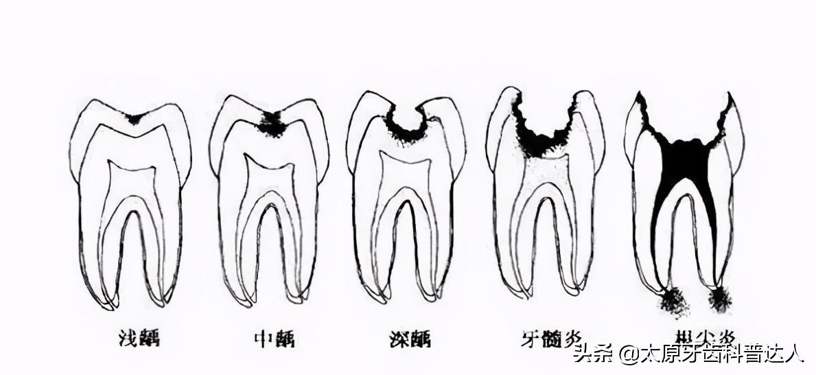 蛀牙蛀到牙根怎么补,蛀牙的食物克星