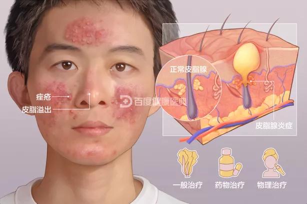 根治痘痘的最有效方法,真正能够根治痘痘的方法