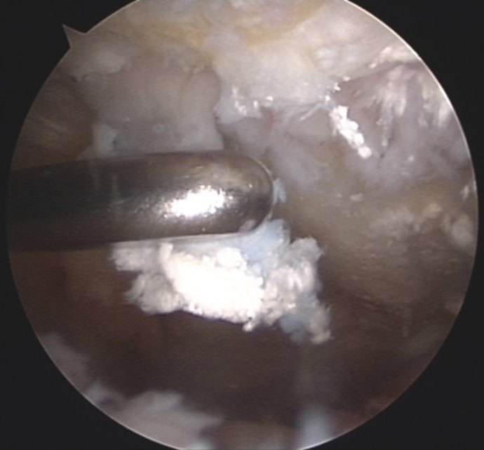 关节炎与痛风性关节炎有什么区别,关于痛风的30个辟谣的问题