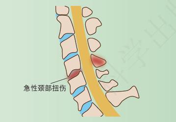 颈椎生理曲度变直有骨刺怎么办,颈椎x线片能看到什么吗