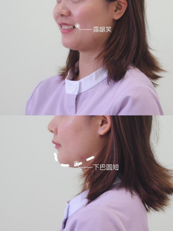 我戴牙套了日记,我戴了牙套两天牙齿松