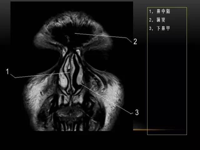 鼻腔鼻窦及颅底ct影像解剖,鼻窦解剖mri
