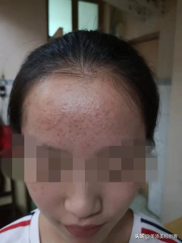 肠胃湿热症导致的闭口开口粉刺痘，这样对症而治少走很多弯路！