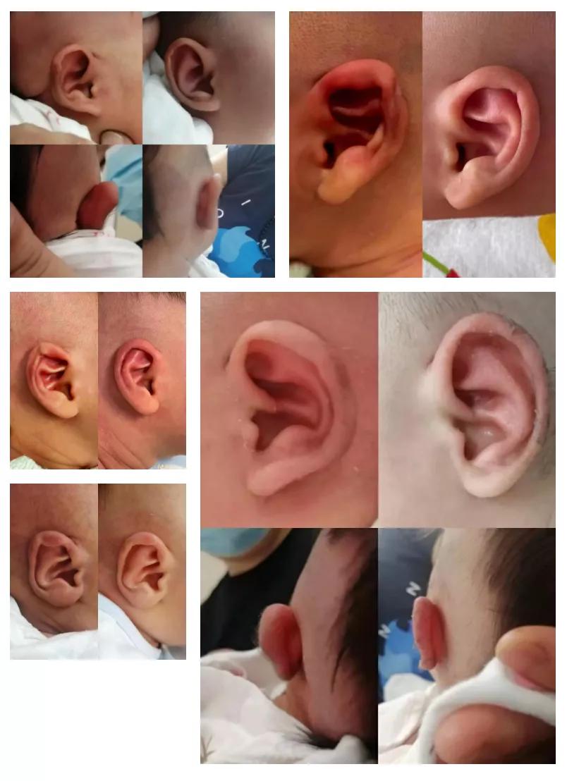 新生儿耳廓畸形需要抹什么药定型,新生儿耳朵轮廓畸形家长怎么办