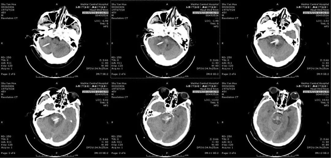 脑干出血五毫升还有救吗,脑干出血5ml危险期