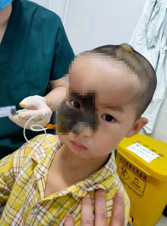 5岁男孩头上长500克重“气球”，历尽5年艰辛只为早日换脸