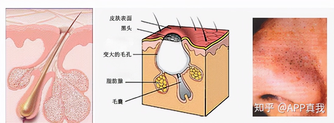 11岁女孩鼻子上有黑头怎么去除,黑头怎么形成的原因