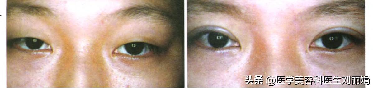 尚雯婕单眼皮吗,尚雯婕参加王牌视频