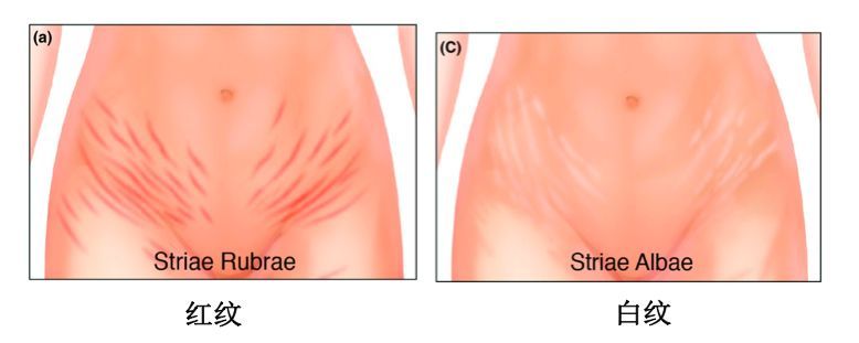 生长纹肥胖纹之前有什么反应,生长纹肥胖纹是长什么样
