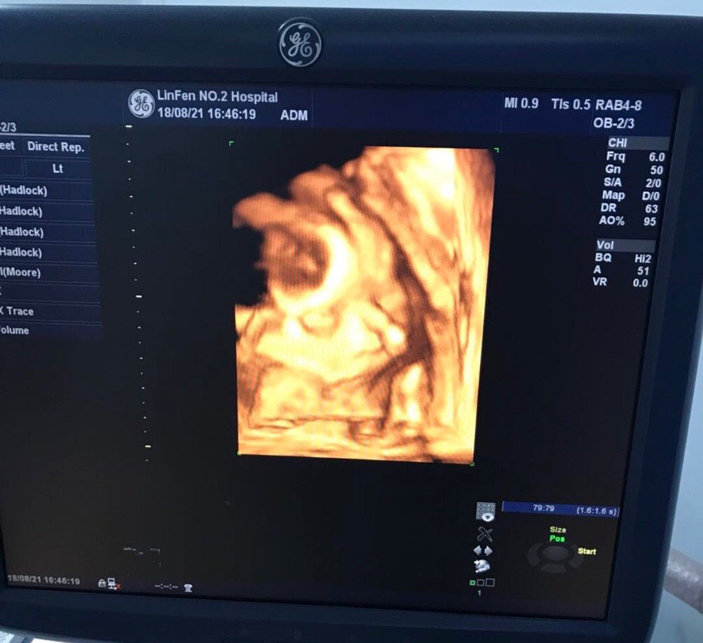 孕妈咪必须了解的自然分娩技巧,头胎孕妇顺产经历