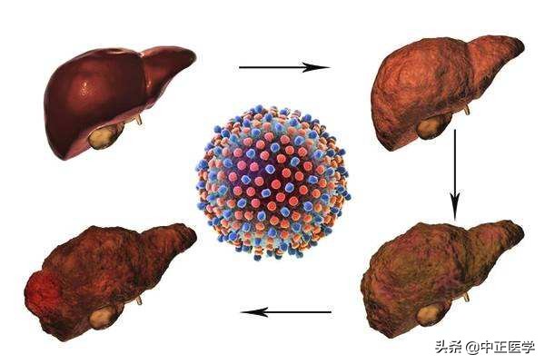 中毒到重度的肝炎能治好吗,肝炎能治好吗病毒性肝炎
