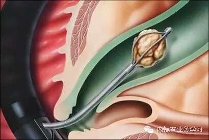 肝内胆管结石怎么治疗,肝胆管结石中医治疗