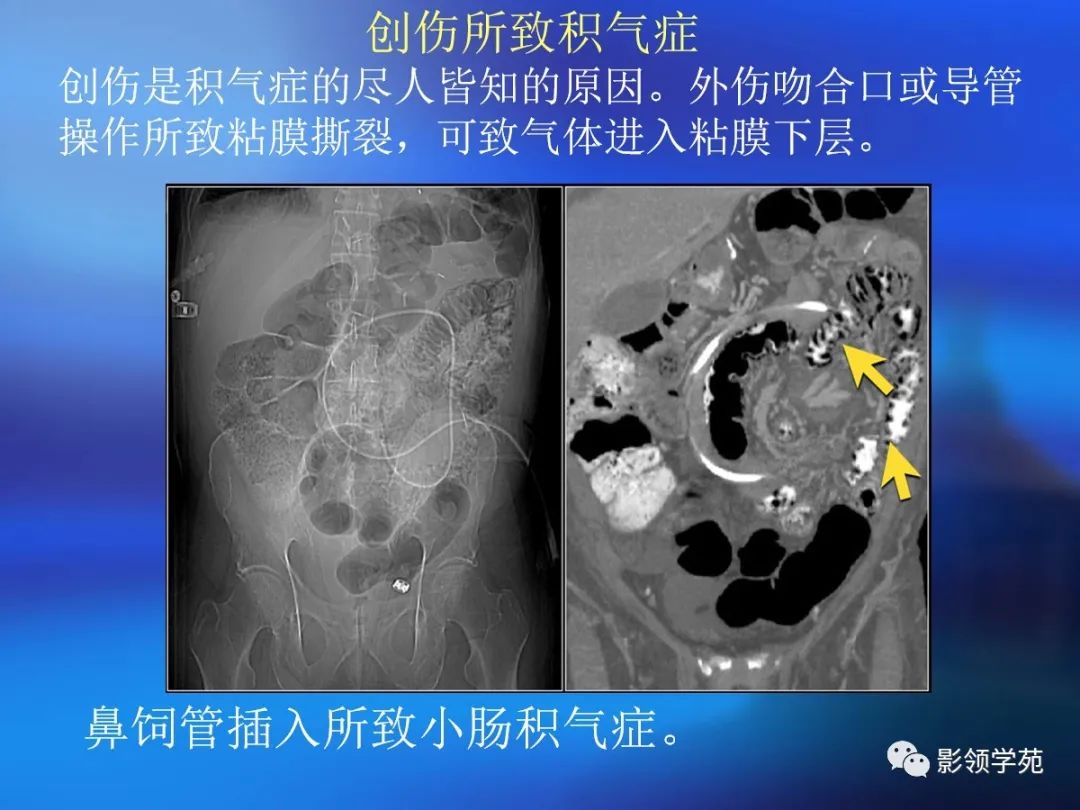 肠道内壁增厚,肠道扩张ct表现
