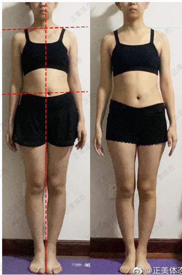 简单脊柱侧弯训练动作两个,1岁脊柱侧弯矫正动作