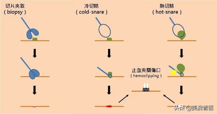 肠息肉大于2cm可以肠镜切除干净吗,肠息肉切除的几种方法