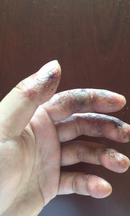 望大V能够分享一下|真实经历分享#钓鱼人#职业病之香虎手治疗方案