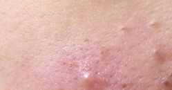 你们的痘痘最后都是怎么完全好的？反正我是用了这个方法才好的