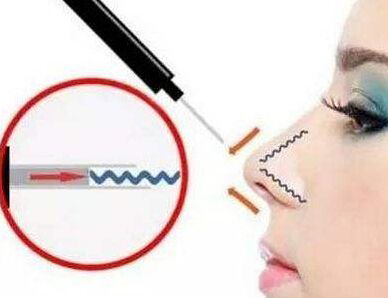 玻尿酸隆鼻效果能维持多久,玻尿酸隆鼻注意事项及禁忌