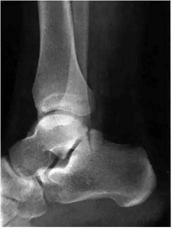 踝关节撞击症问诊,踝关节内侧撞击综合症位置图