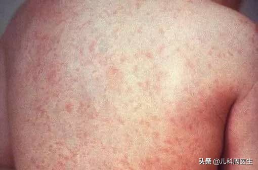 反复发热有没有可能是幼儿急疹,小孩急疹和热疹的区别