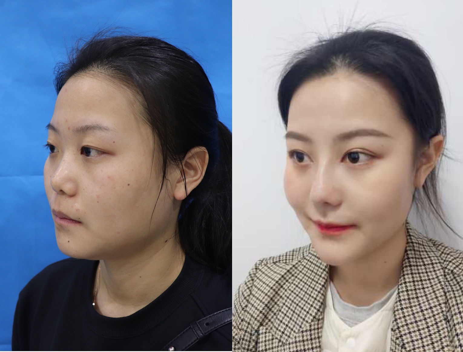 五官扁平的大饼脸,大饼脸和扁平五官怎样自救