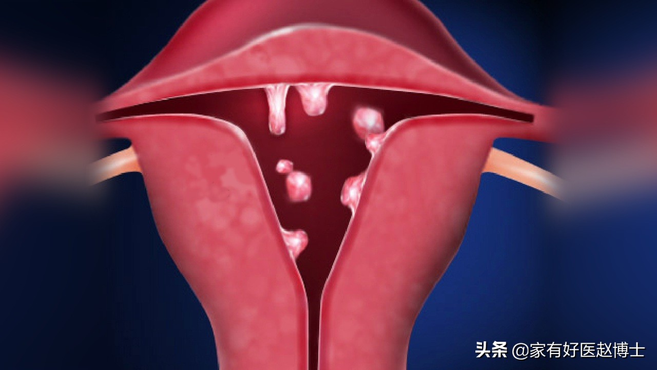 最常见5类息肉每个人都可能有，哪些无癌变风险，哪些需要切除？