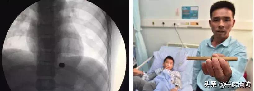 保护儿童丨一名男童因它致小肠切除30厘米！这些危险玩具你家可能也有！