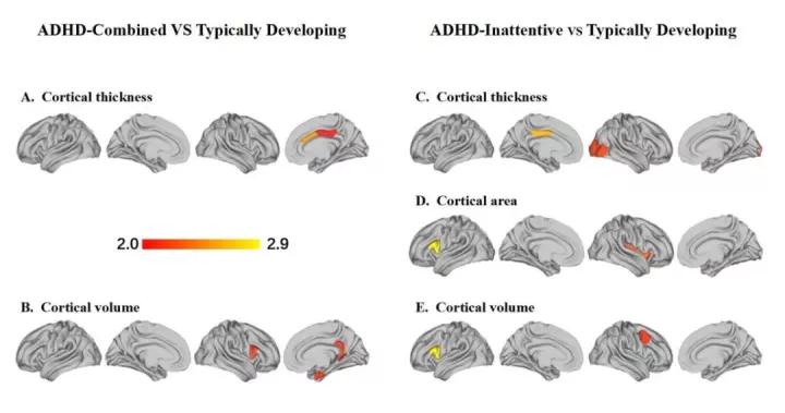 有效治疗阿尔茨海默病,阿尔茨海默病治疗迎突破