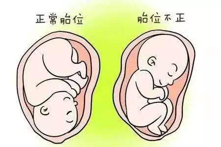 胎位不正有什么最快最好的办法,为什么胎位不正不能顺产