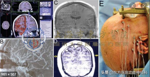 反复牙痛一定要拔牙根治吗,牙齿疼痛会诱发癫痫吗