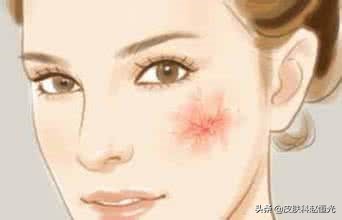 脸上老是出现红血丝是什么原因,脸上有血丝是什么原因男士