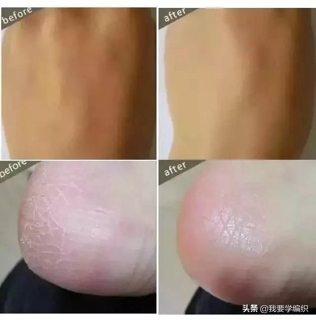 冬天干燥皮肤蛇皮,冬天冷皮肤粗糙