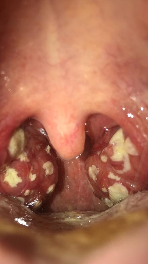 小宝高烧不退甲流,小宝持续高烧不退怎么办