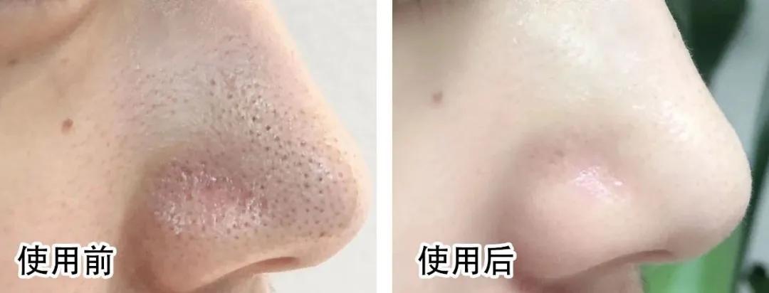 去角质慕斯可以去除死皮么,去角质慕斯去不去死皮