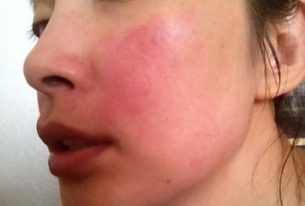 激素的副作用怎么预防的,激素脸遇到激素会怎样