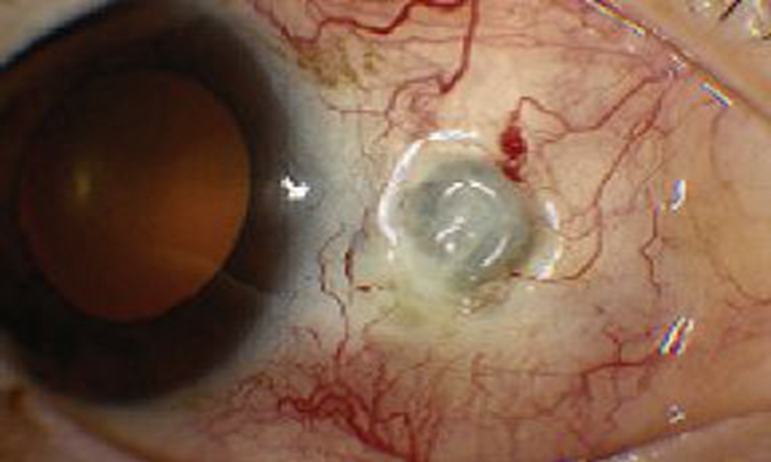 【疾病认知】白睛青蓝